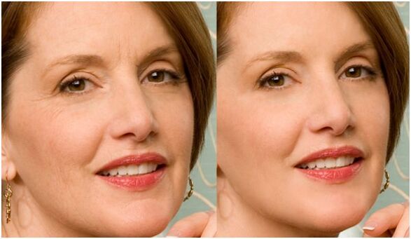 sebelum dan selepas peremajaan kulit wajah plasma