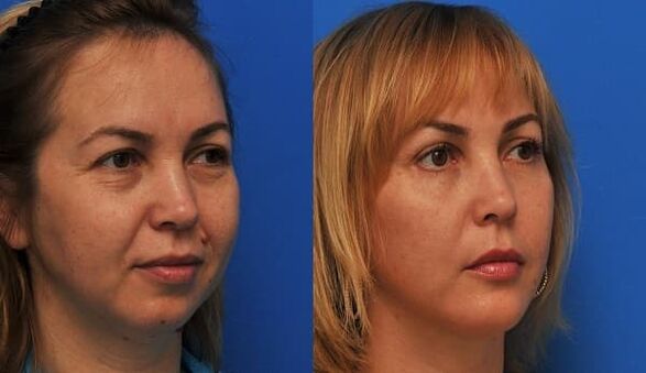 sebelum dan selepas peremajaan kulit dengan mengetatkan Foto 1