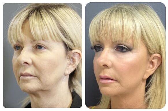 sebelum dan selepas peremajaan kulit dengan mengetatkan Foto 2