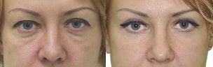 Foto sebelum dan selepas kontur kelopak mata